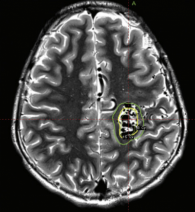 <a href="aktualnoscinajnowsze-informacje-o-prowadzonych-projektach/radioterapia-stereotaktyczna-u-dzieci-czy-mozna-stosowac-schematy-leczenia-jak-u-doroslych" target="_self">Radioterapia stereotaktyczna u dzieci – czy można stosować schematy leczenia jak u dorosłych?</a>
