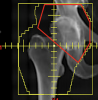 <a href="aktualnoscinajnowsze-informacje-o-prowadzonych-projektach/radioterapia-w-leczeniu-chorych-ze-zwyrodnieniem-stawow" target="_self">Radioterapia w leczeniu chorych ze zwyrodnieniem stawów.</a>