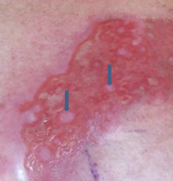 <a href="aktualnoscinajnowsze-informacje-o-prowadzonych-projektach/zalecenia-estro-dotyczace-postepowania-w-przypadku-popromiennego-zapalenia-skory" target="_self">Zalecenia ESTRO dotyczące postępowania w przypadku popromiennego zapalenia skóry</a>