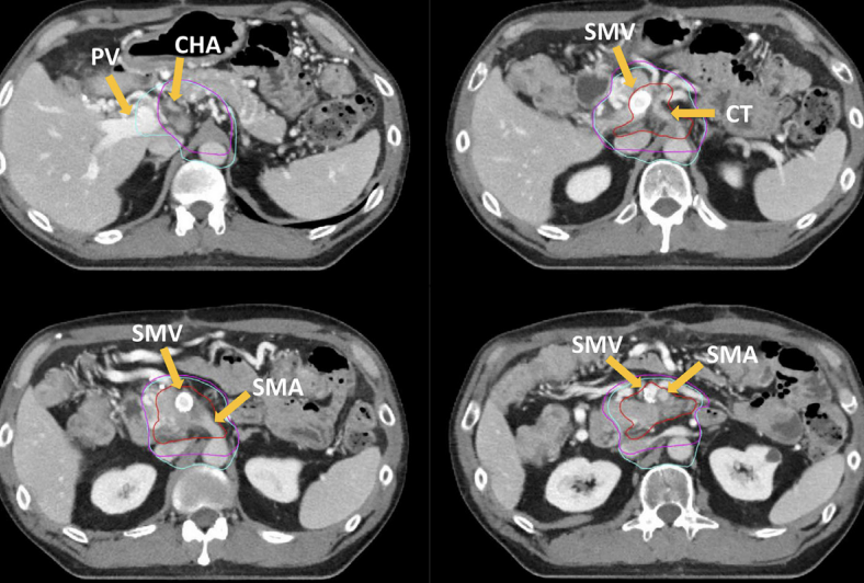 <a href="aktualnoscinajnowsze-informacje-o-prowadzonych-projektach/konturowanie-i-schematy-eskalacji-dawki-w-radioterapii-chorych-na-raka-trzustki-konsensus-nrg-oncology-i-przypadek-kliniczny" target="_self">Konturowanie i schematy eskalacji dawki w radioterapii chorych na  raka trzustki  – konsensus NRG Oncology i przypadek kliniczny. </a>