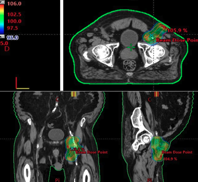 <a href="aktualnoscinajnowsze-informacje-o-prowadzonych-projektach/radioterapia-w-leczeniu-chlonkotoku" target="_self">Radioterapia w leczeniu chłonkotoku.</a>